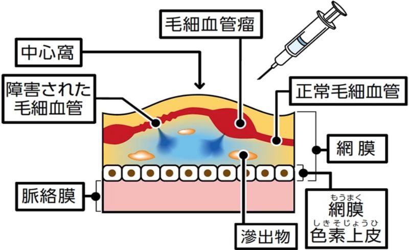 糖尿病黄斑浮腫とは