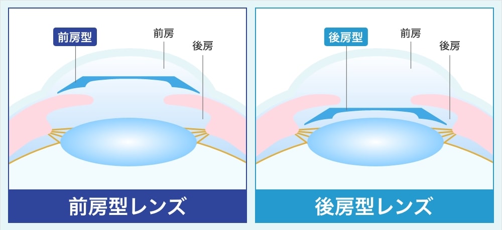 眼の構造と前房型レンズと後房型レンズの挿入位置の比較図