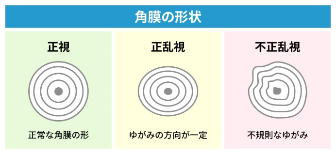 角膜の形状を示す3つの図