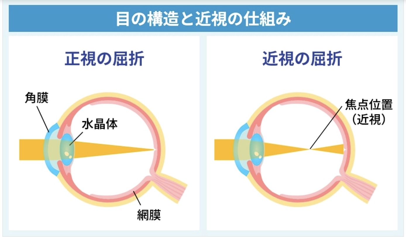 近視の仕組み