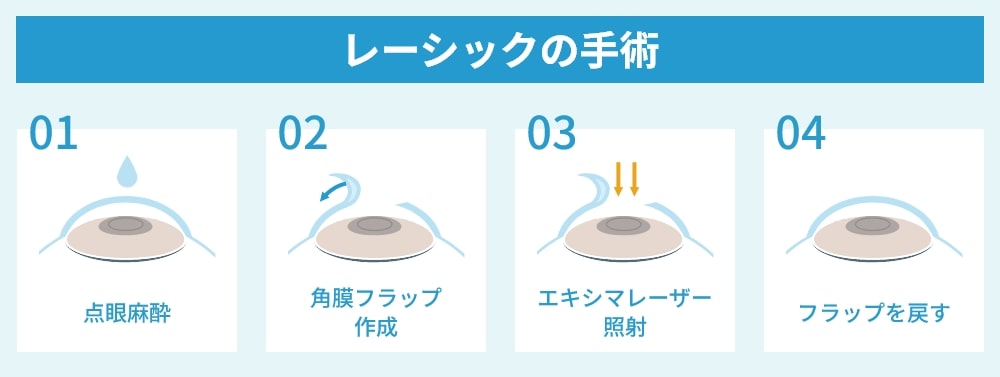レーシックの手術
