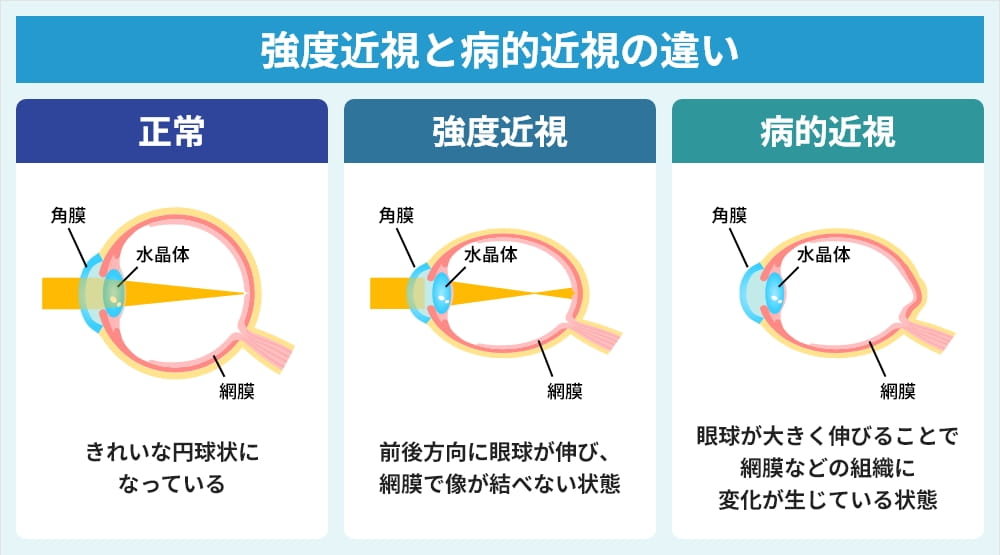 強度近視 病的近視