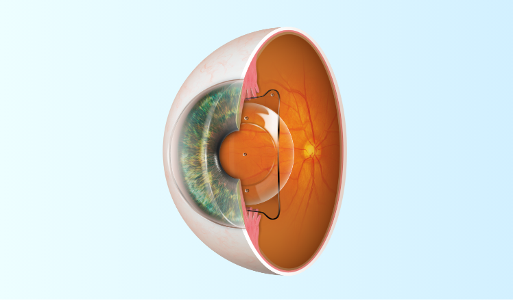 ICLを挿入した眼球