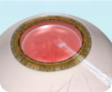 角膜を約3mm切開