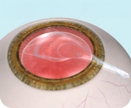 レンズ(ICL)を挿入