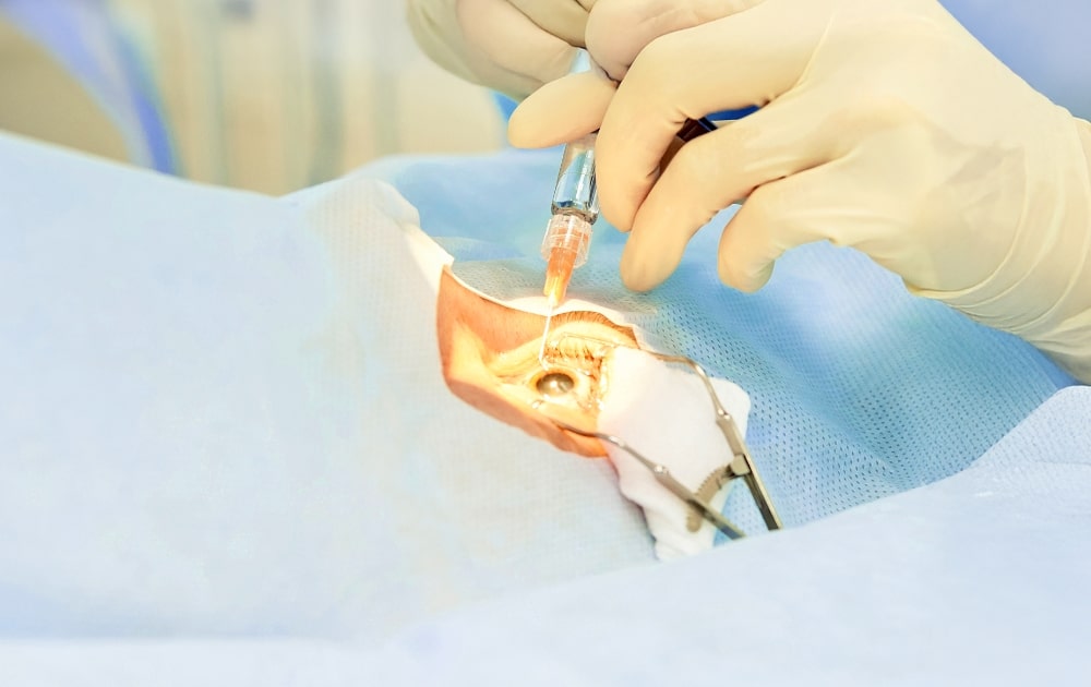 レーシックで治せる乱視・治せない乱視