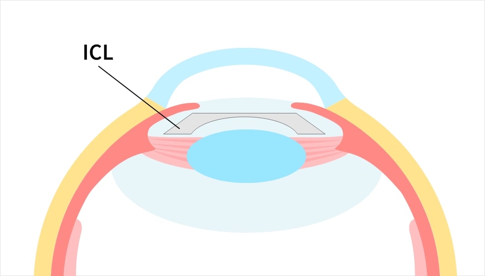 ICL手術