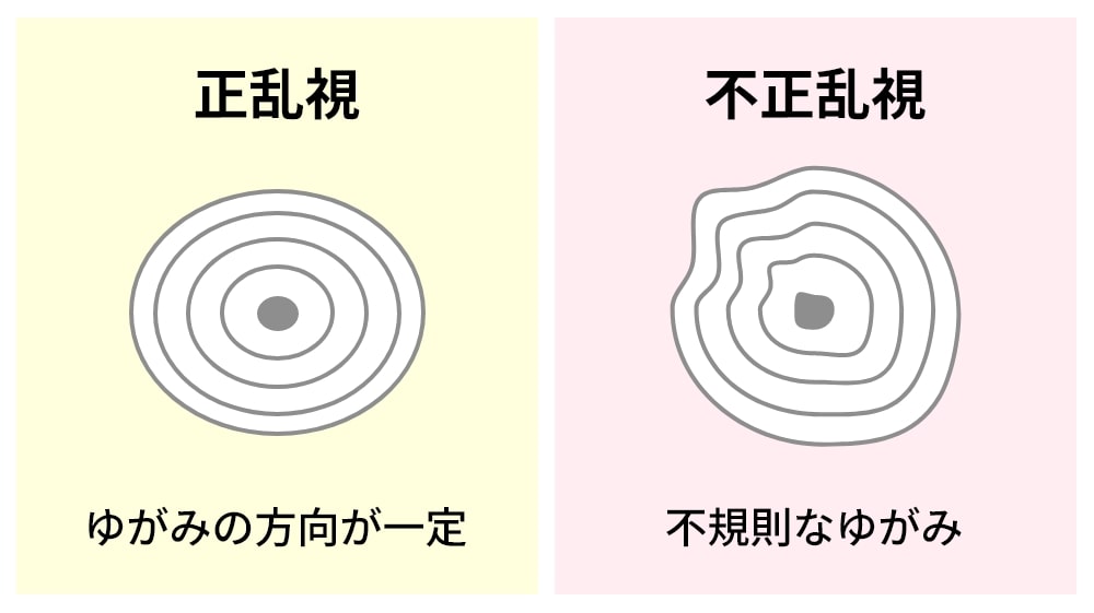 正乱視と不正乱視