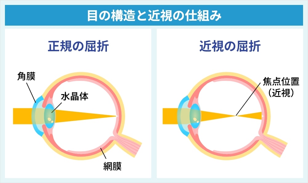 近視の仕組み