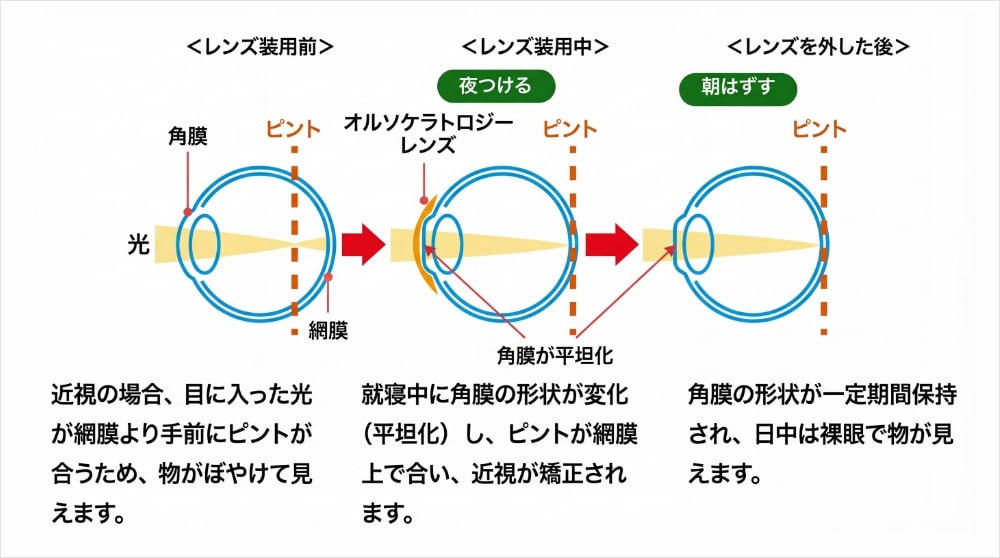 オルソケラトロジーレンズ装用