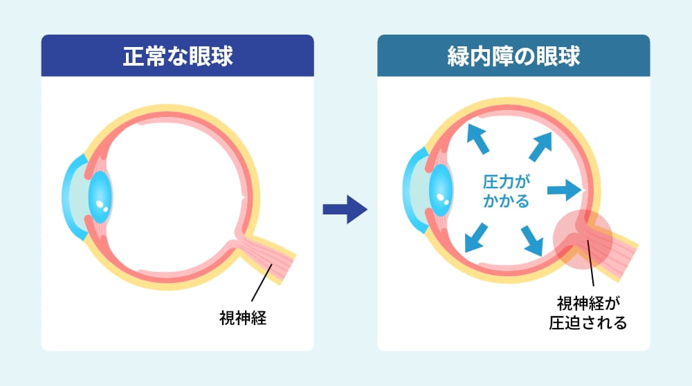 正常な眼球と緑内障の眼球