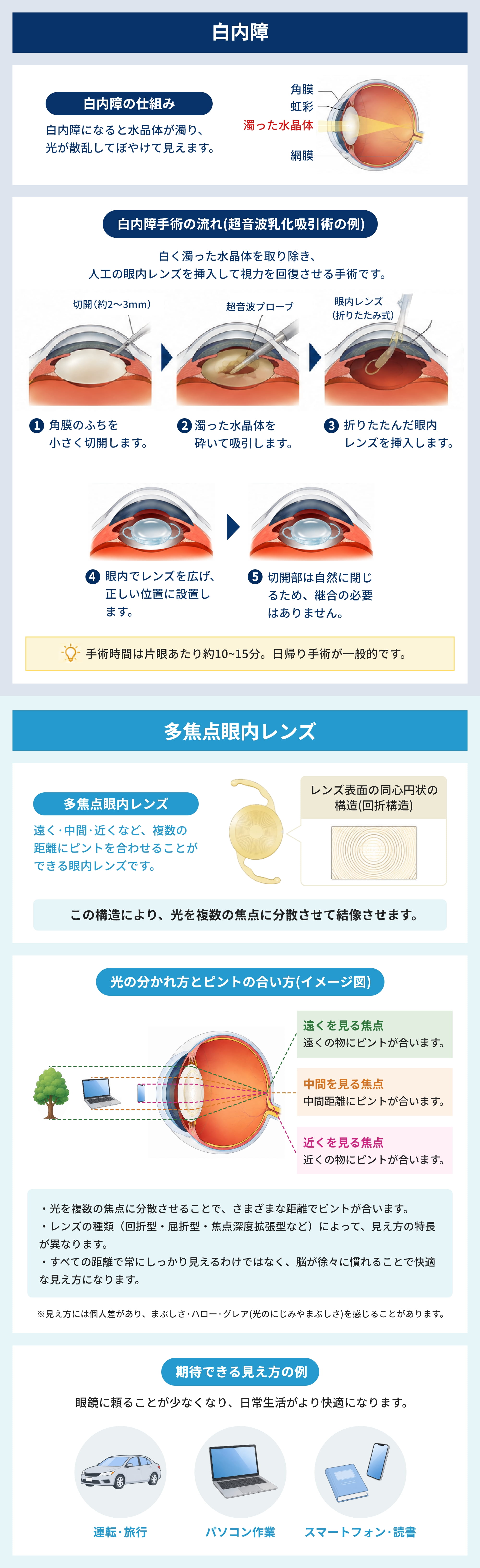 白内障の状態と多焦点眼内レンズの仕組み