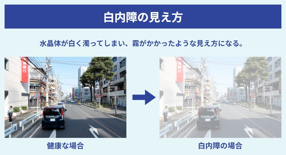 白内障の見え方