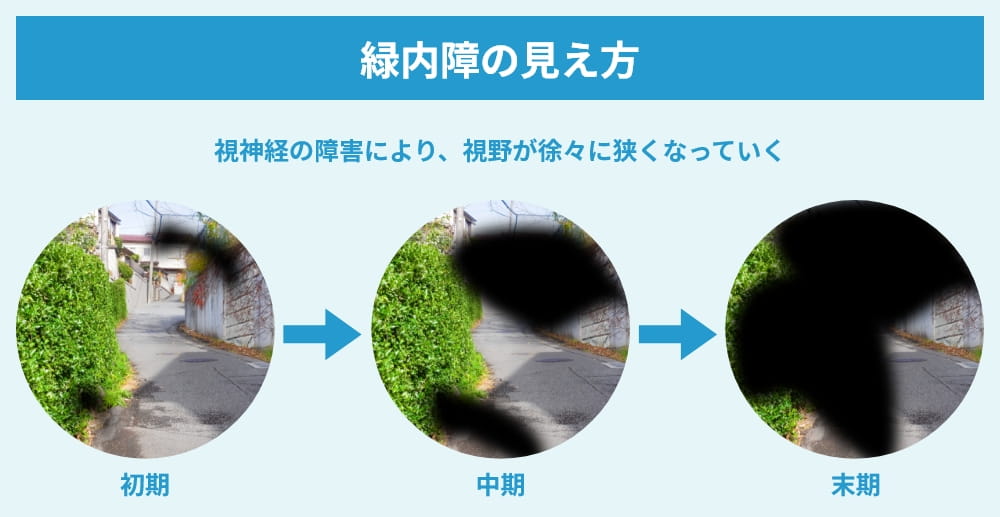 緑内障の見え方