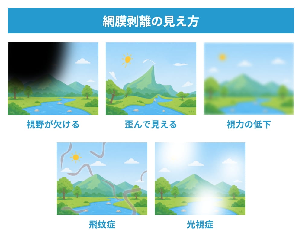 網膜剥離の見え方