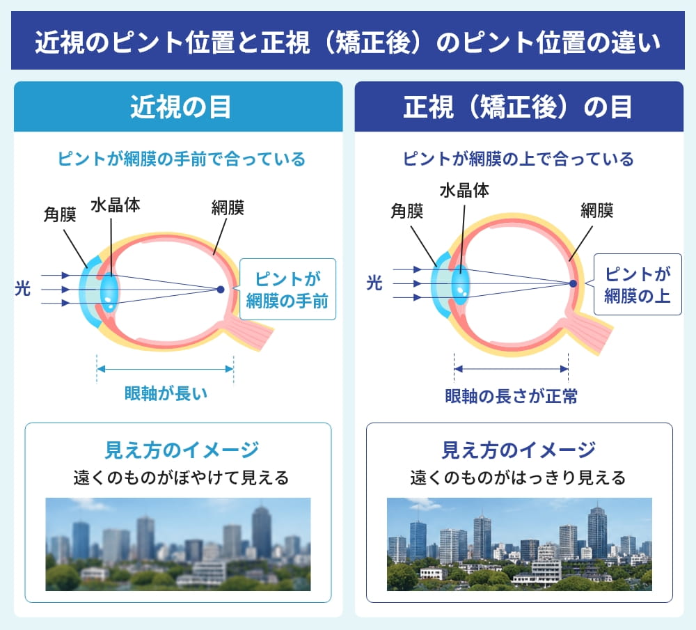 近視と正視における眼球の焦点位置と見え方