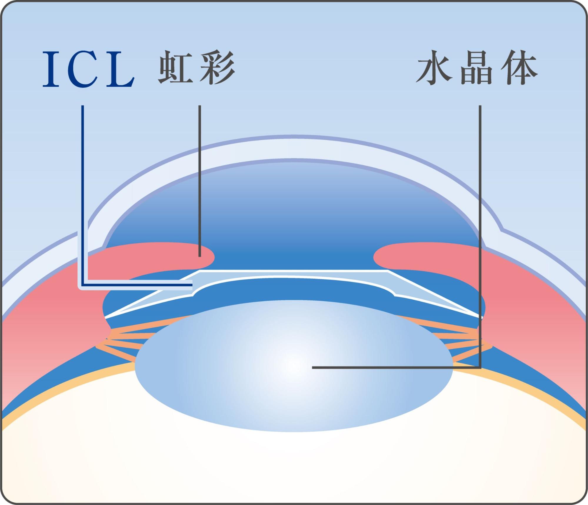 ICLレンズの挿入位置
