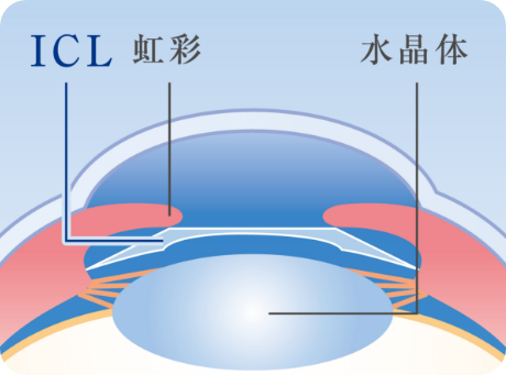 ICL