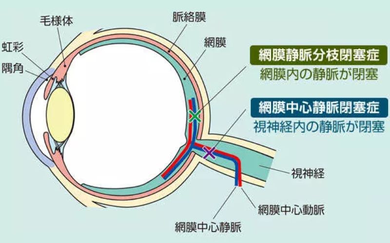網膜静脈閉塞症とは