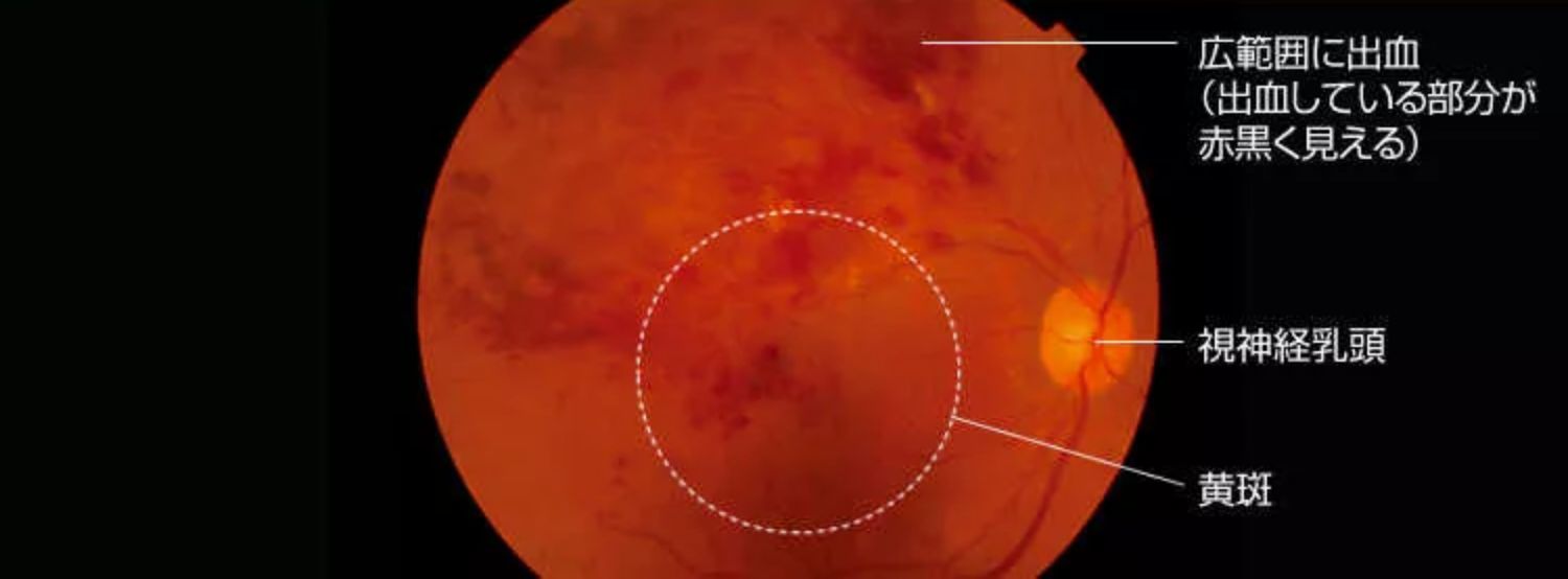 網膜静脈分枝閉塞症の初期症状