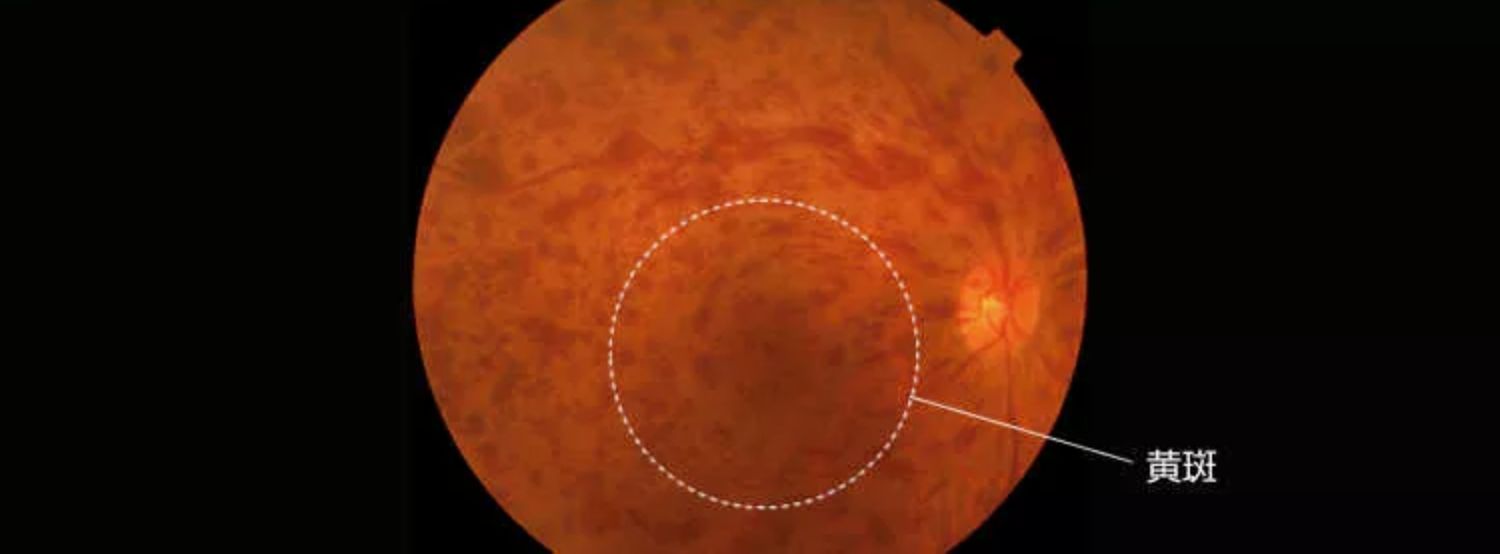 網膜静脈分枝閉塞症の初期症状