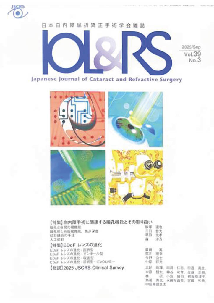 EDoFレンズの進化：収差型. 日本白内障屈折矯正手術学会雑誌39巻3号今野公士
